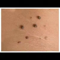 درمان قطعی زگیل و تبخال با ضمانت|آرایشی، بهداشتی، درمانی|کرمانشاه, |دیوار