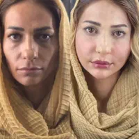 لیفت و جوانسازی صورت با ارزان ترین قیمت توسط پزشک|خدمات آرایشگری و زیبایی|مشهد, هنرستان|دیوار