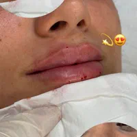 اف فیلرلب گونه چونه زاویه فقط 649|خدمات آرایشگری و زیبایی|محمدیه-قزوین, |دیوار