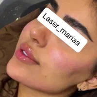 لیزرمو زائدبدن،تزریق ژل،بوتاکس،پاک کردن تتوبالیزر