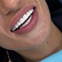 کامپوزیت دندان بابهترین موادفقط وفقط واحدی۹۹۹|خدمات آرایشگری و زیبایی|نیشابور, دارایی|دیوار