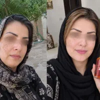 لک و تیرگی پوست قبل از انتخاب ضدلک اینو بخون