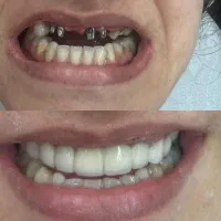 دندانپزشکی ایمپلنت روکش ارتودنسی اقساطی|خدمات آرایشگری و زیبایی|مرند, |دیوار