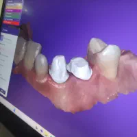 آموزش طراحی دندان دیجیتال با اگزوکد و میلینگ