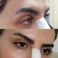 لیفت شقیقه وگونه با جراحی|خدمات آرایشگری و زیبایی|بوکان, |دیوار