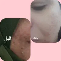 مشاوره تخصصی پوست ومو وپیشنهاد بهترین محصولات|آرایشی، بهداشتی، درمانی|مریوان, |دیوار