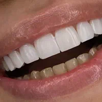 تخفیف 30% کامپوزیت دندان