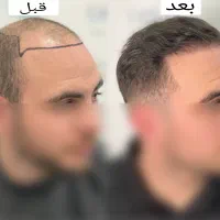 کاشت موی رایگان تبریز