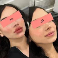 ژل لب و صورت/فیلر بادی/بوتاکس/مزوژل ۳۰٪ تخفیف