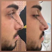 اصلاح فرم بینی بدون جراحی و بیهوشی توسط پزشک|خدمات آرایشگری و زیبایی|قم, دورشهر|دیوار