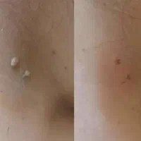 درمان سطحی زگیل در عرض ۳ روز