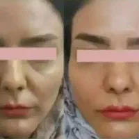 جوانه گندم چاقی صورت