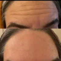 تزریق ژل وبوتاکس و آموزش فیلر با 5سال سابقه کاری|خدمات آرایشگری و زیبایی|جیرفت, |دیوار