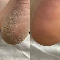 تخفیف ویژه ‌پدیکور( کف سابی ) با دستگاه  ۶۵۰