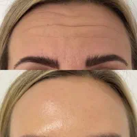 کره ای ،اصل تضمینی فیلر بزن از همه جا مناسب تر