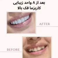 آف ویژه بالن وبوتاکس معده،ژل و بوتاکس وبفاروپلاستی|خدمات آرایشگری و زیبایی|اهواز, کیانپارس |دیوار
