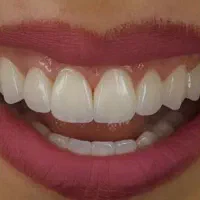 ارتودنسی، کامپوزیت، ترمیم طرف بیمه ها(اقساط)|خدمات آرایشگری و زیبایی|بم, |دیوار