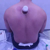 حجامت درمانی فیزیوتراپی وروغن و بادکش ورزشی