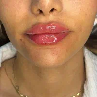 نیازمند مدل فیلرلب/چانه/گونه/زاویه/بوتاکس|خدمات آرایشگری و زیبایی|کرج, گلشهر|دیوار