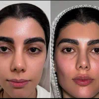 ژل و بوتاکس با تخفیف ۵۰ درصدی توسط پزشک