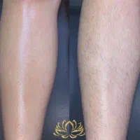 اپیلاسیون بدون درد