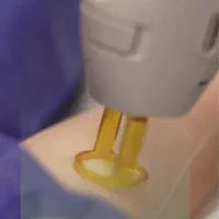 دعوت به همکاری از اپراتور مهمان با  لیزر کندلا