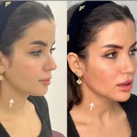 کلینیک تخصصی پوست هایفو ژل نخ آموزش حرفه ای ژل نخ|خدمات آرایشگری و زیبایی|تهران, زعفرانیه|دیوار