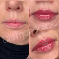 فیلر بوتاکس متخصص زیبایی|خدمات آرایشگری و زیبایی|تبریز, |دیوار