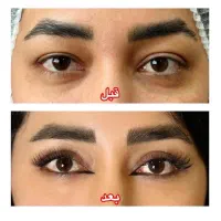 تخفیف بلفاروپلاستی(پف پشت چشم)بخیه لیزری