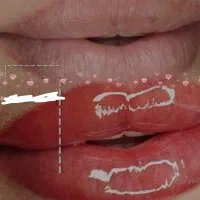 خدمات تخصصی رفع تیرگی لب و شیدینگ لب