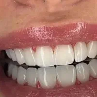 لبخندی زیبا با کامپوزت ۵۰٪off