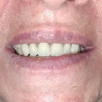 ساخت دندان مصنوعی اقتصادی با خدمات در منزل|خدمات آرایشگری و زیبایی|ری, دیلمان|دیوار