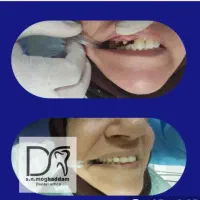 روکش برای دندان شکسته