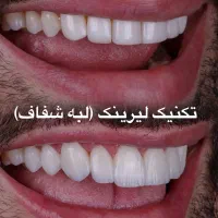 دندانپزکشی کامپوزیت لمینین و روکش زیبایی