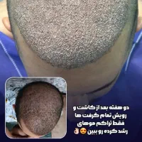کاشت موی طبیعی|استخدام درمانی، زیبایی، بهداشتی|تهران, جردن|دیوار