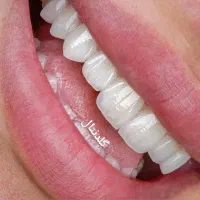 کامپوزیت دندان روکش تخفیف ویژه دندانپزشکی تهرانسر