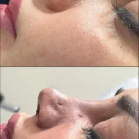 عمل زیبایی بینی با ۲۵ میلیون