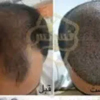 استخدام تکنسین کاشت مو