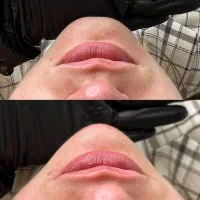 تزریق ژل و بوتاکس|خدمات آرایشگری و زیبایی|کرج, گلشهر|دیوار