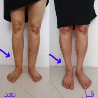 مژده همشهریان عزیزتخفیف 30 درصد خدمات جراحی ساکشن|خدمات آرایشگری و زیبایی|بروجرد, |دیوار