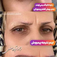 شیدینگ لب و میکرویلیدینگ در شهرری
