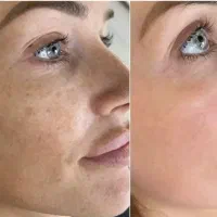 ریموکک ومک دریک جلسه،فشیال تخصصی صورت وچشم
