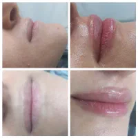 تزریق تخصصی فیلر،بوتاکس،مزو وآنزیم درمطب|خدمات آرایشگری و زیبایی|کرمانشاه, |دیوار