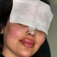 جشنواره ویژه ژل و بوتاکس|خدمات آرایشگری و زیبایی|اردبیل, |دیوار