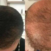 پکیج قطع ریزش و رویش مجدد فرانسوی المانی