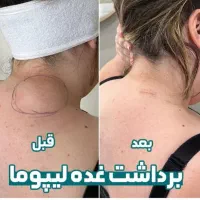 جراحئ غده چربئ در منزل