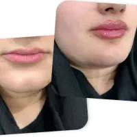 ژل بوتاکس پی از پی مزو فیشال میکرو فیلر بیکنی|خدمات آرایشگری و زیبایی|مشهد, فرهنگیان (شهرک غرب)|دیوار