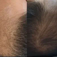 معجزه رویش موی سر وریش