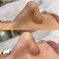 آموزش پاکسازی پوست و فشیال