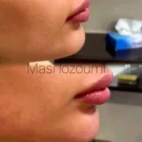 مرکز تخصصی ژل و بوتاکس در قزوین|خدمات آرایشگری و زیبایی|قزوین, |دیوار